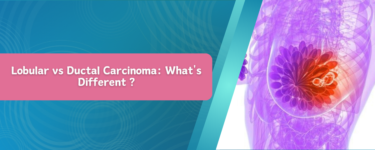 Lobular vs Ductal Carcinoma: What’s Different ?