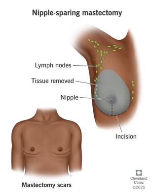 Medical illustration of a nipple-sparing mastectomy: preserved nipple, removed tissue, incision on the breast, with labeled lymph nodes and mastectomy scars.