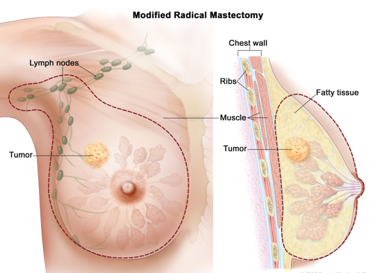 Modified radical mastectomy illustration: left breast tumor with nearby lymph nodes and dashed surgical outline; inset shows chest wall anatomy labeled ribs, muscle, tumor, and fat tissue.
