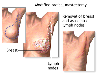 Picture3 | Dr Garvit Diagram of modified radical mastectomy showing removal of breast tissue and nearby lymph nodes with labeled incisions and dotted path indicating incision area.