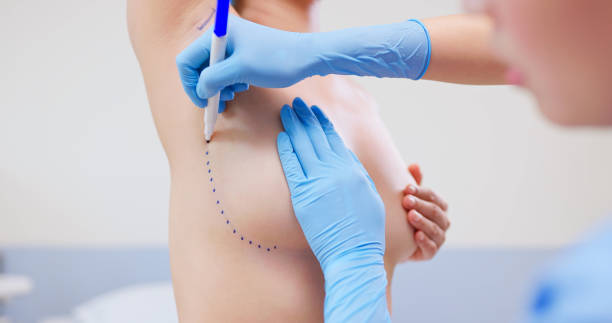 Blue-gloved medical professional marks a curved incision line on a patient’s abdomen with a marker.