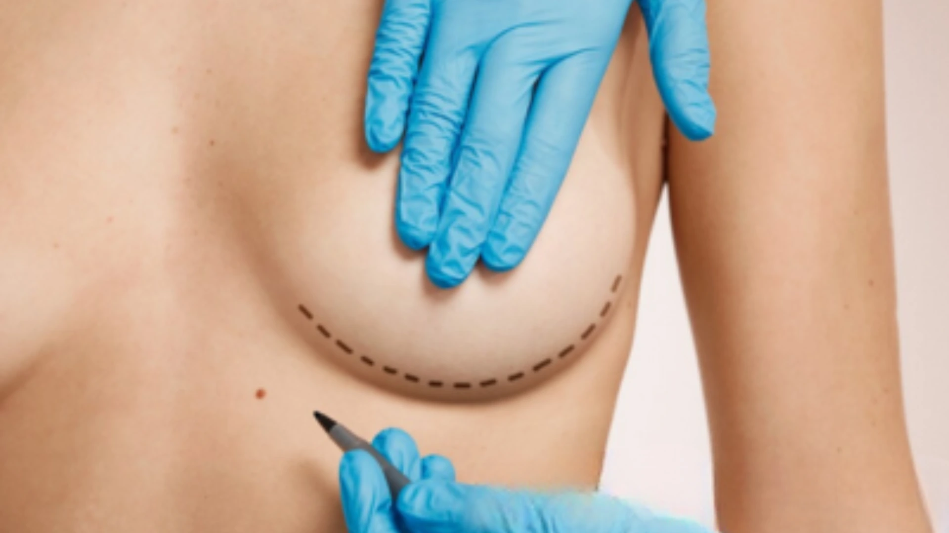 Untitled design 1 1 | Dr Garvit Medical scene of breast surgery prep with blue-gloved hands holding a scalpel near a dotted under-breast incision mark.