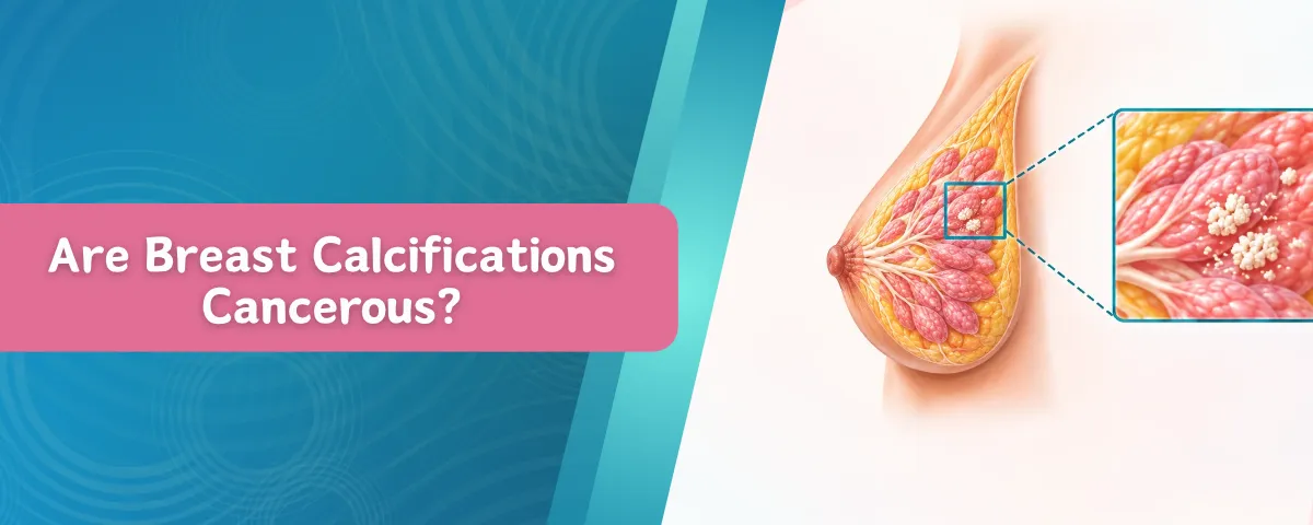 Are Breast Calcifications Cancerous?
